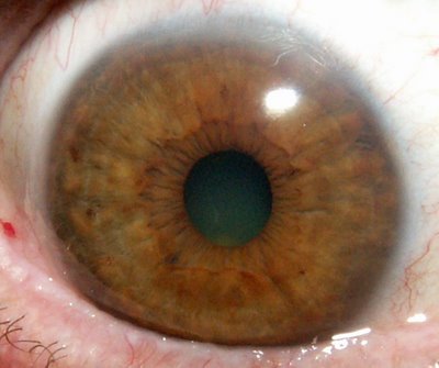Iridologia. Iris en estado degenerativo